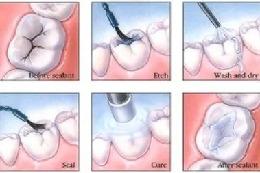 Dental Sealants