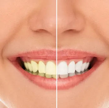 Teeth Whitening