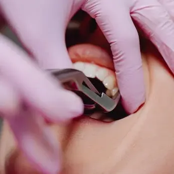 Tooth Extractions